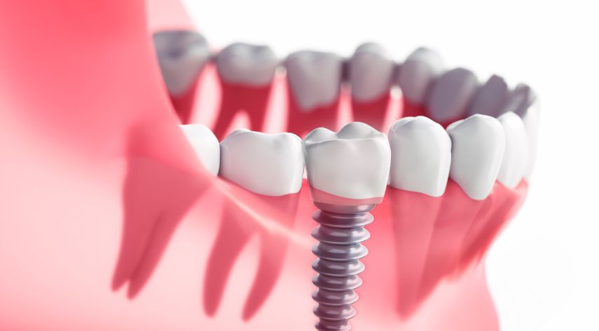 Dental ImplantProcedure