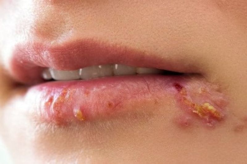 Everything You Need to Know About Herpes