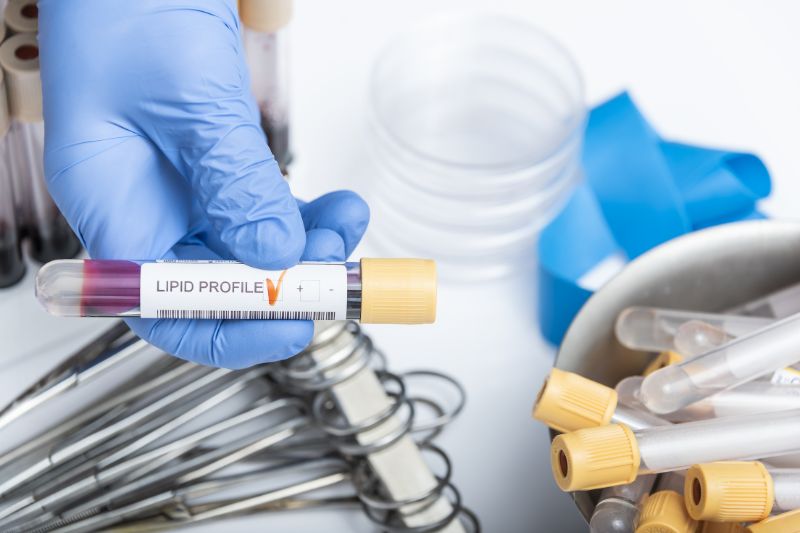 What Does A Lipid Profile Test Measure? Let’s Find Out